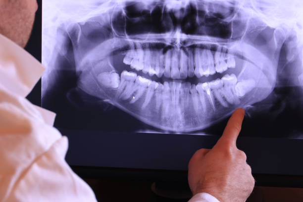 Best Emergency Wisdom Tooth Extraction in Carrier Mls, IL